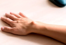 ganglion kisti